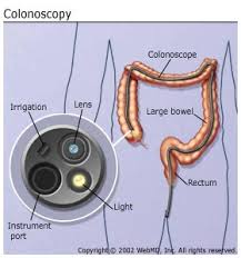 colonoscopy