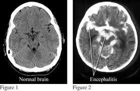 encephalitis