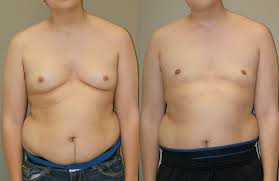 gynecomastia