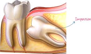 impaction