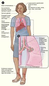 sarcoidosis