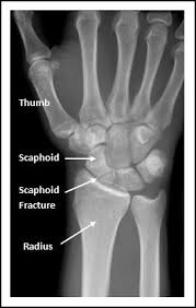 scaphoid