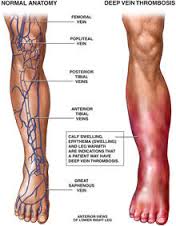 thrombophlebitis